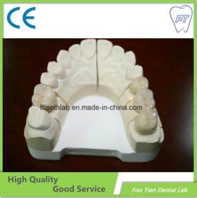 Selling Dental Metal Ceramic Crown Made in Foo Tian Dental Lab in Shenzhen China