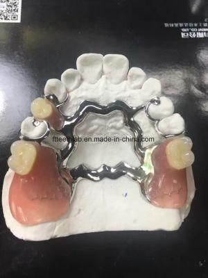 Vitallium Casting Framework Denture