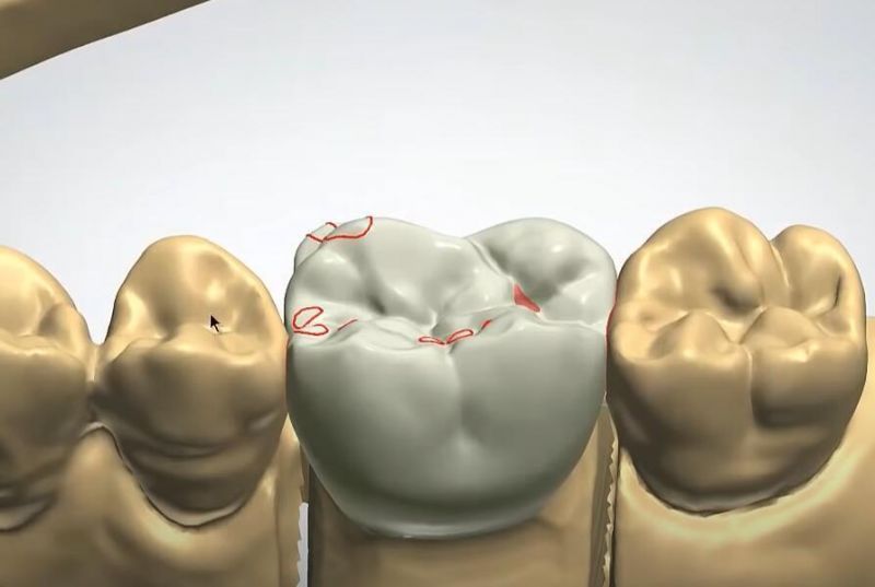 Dental Crown Bridge Veneer Metal Framework Implant Bar Design Service