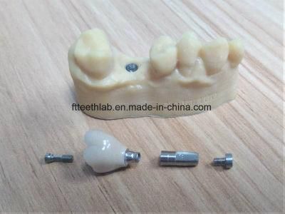 CAD Cam Designed Dental Implant Crowns and Bridge