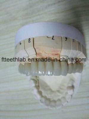 Co/Cr Metal Fused to Ceramic Bridge From China Dental Lab
