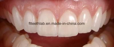 Dental Emax Veneers Made in China Dental Lab