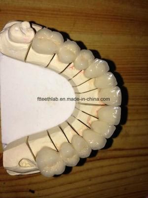 Dental Metal Ceramic Bridge Made in High-End China Dental Lab
