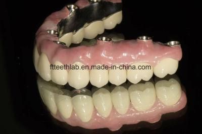 Full Mouth Rehabilitation Implant Bridge