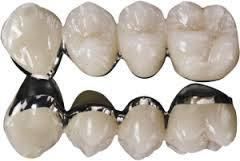 Dental Pfm Crown From China Dental Lab