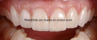 Dental Emax Facings for Cosmetic Dentistry