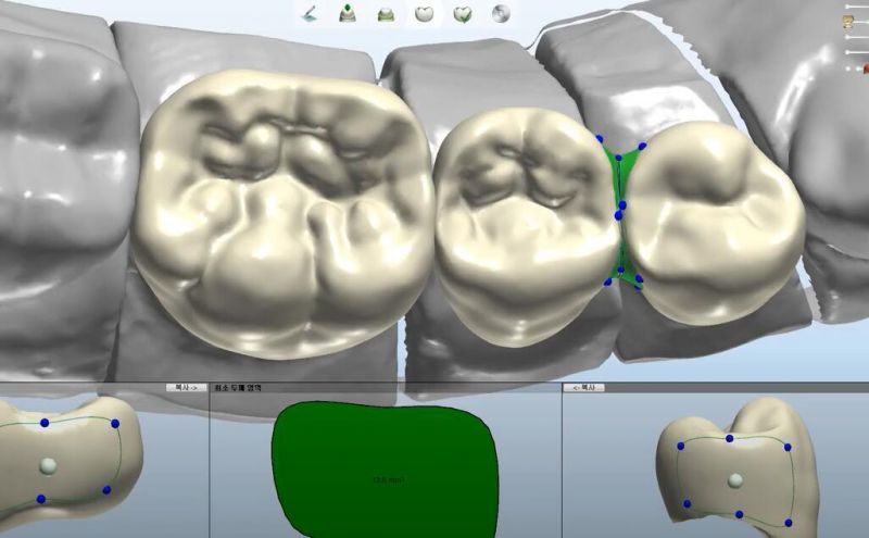 Dental Crown Bridge Veneer Metal Framework Implant Bar Design Service