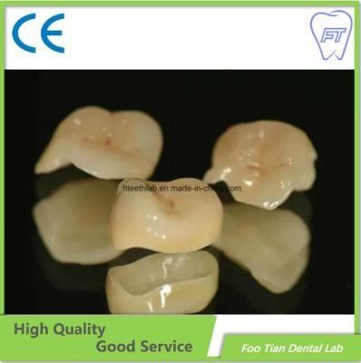 Orthodontic Products Dental Material Supplies Implant Emax Ceramic Inlay/Onlay From China Dental Lab