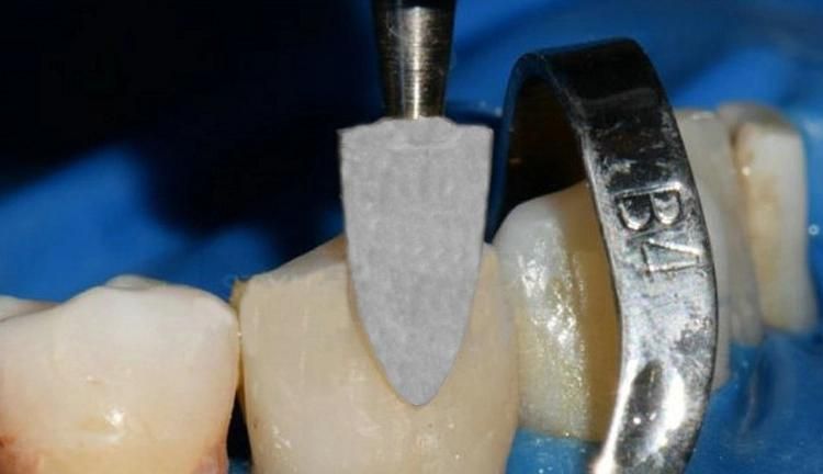 Dcr122 High Quality High-Speed Dental Diamond Impregnated Stone Bur Dental Diamond Tool