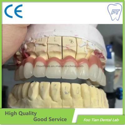 Foo Tian Brand Dental Metal Ceramic Crown Made in Foo Tian Dental Lab in Shenzhen China