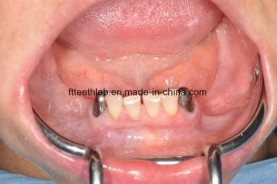 Removable Telescope Metal Cast Partial Dentures Made in China Dental Lab