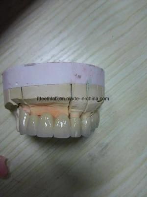 Dental Pfm Bridge Made in High Quality China Dental Lab in Shenzhen China