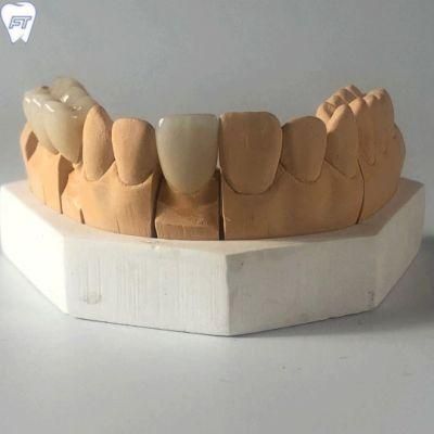 Zirconia Crown Made From China Dental Lab with High Aesthetic and Natural Looking