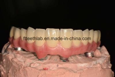 Zygomatic Implants Metal Porcelain Bridge From China Dental Lab