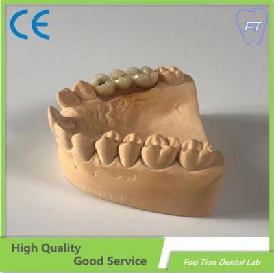 Full Arch Metal Ceramic Implant Bridge with Cemented Retained Dental Lab