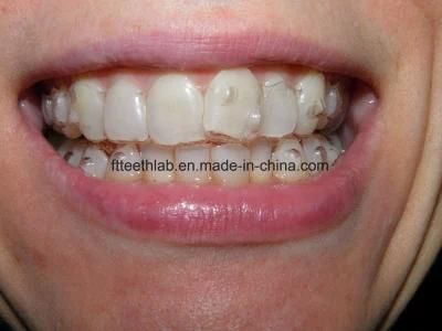 Invisible Orthodontic Mouth Guard From China Dental Lab