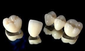 Dental Metal Ceramic Crown From China Dental Lab