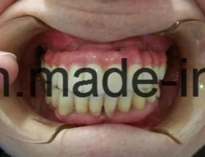 Dental Malo Bridge Made in China Dental Lab