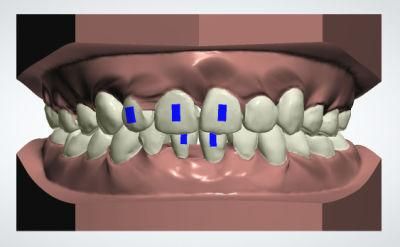 Invisible Aligner Retainer Cost/Perfect Teeth Alignment/Invisible Aligner Clear Aligners