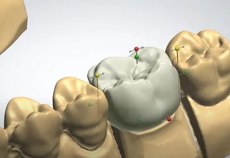 Dental Custom Abutment Full Partial Denture Smile Design Service