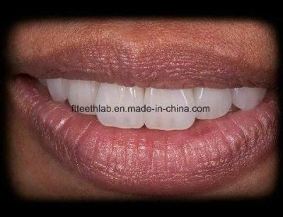 Bright Aesthetic Dental Emax Crown