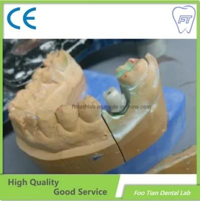 Orthodontics Treatment Custom Abutment Titanium Abutment with High Quality