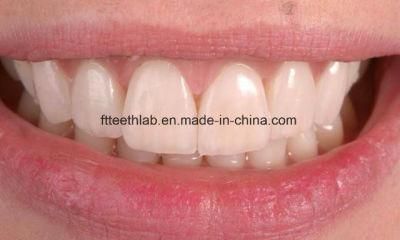 Dental Porcelain Emax Veneers From China Dental Lab