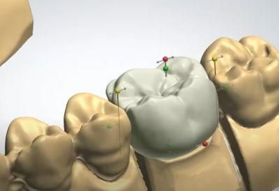 Dental Custom Abutment Full Partial Denture Smile Design Service From China