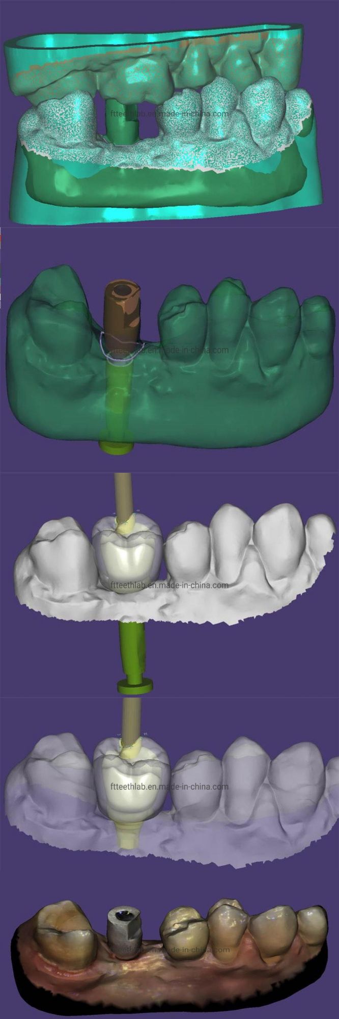 Digital Dental Implant Supplies Ceramiccrown Material Instrument Made From China Dental Lab Dental Implant