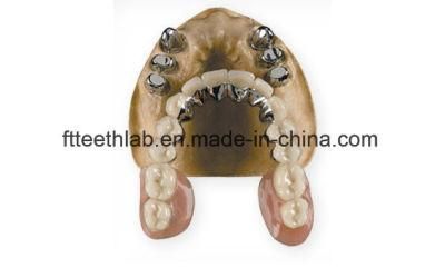 Telescopic Composite Denture From China Dental Lab