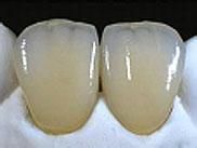 Dental Metal Porcelain Crowns and Bridge From China Dental Lab