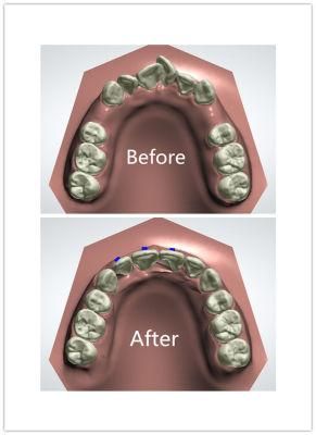 Straighten Your Teeth at Home/Invisible Aligner Line/Invisible Aligner Wisdom Teeth