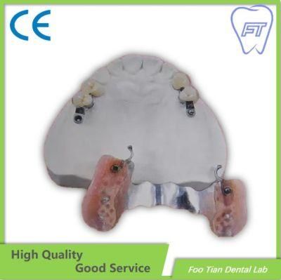 Cast Partial Dental Abutment Dental Treatment on Selling
