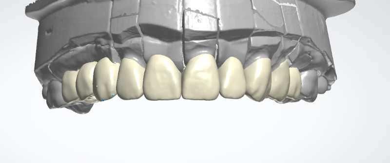 Dental Crown Bridge Veneer Metal Framework Implant Bar Design Service