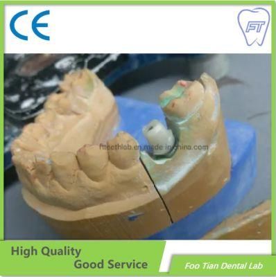High Quality Dental Abutment Dental Restoration Denture