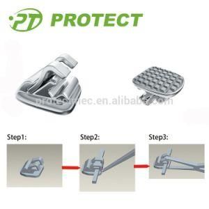 Orothodontic Dental Lingual Brackets for Ortodoncia