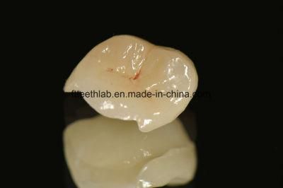 Full Ceramic Emax Inlay Made in China Dental Lab