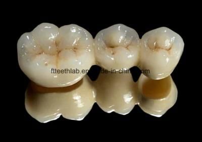 Permanent Dental Crowns Made in Chinese Dental Lab
