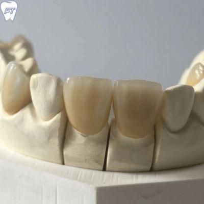 Dental Material Lab Implant Dental Lab Custom Natural and Aeshetic Dental Emax Facings