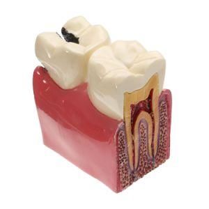 Dental Implant and Restoration Tooth Model Dental Decoration Teach Model