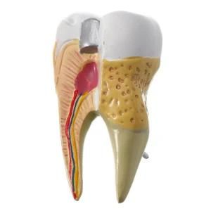 Dental Implant and Restoration Tooth Model Dental Decoration for Teaching