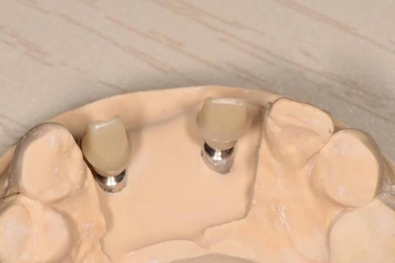 Dental Material Lab Implant Dental Lab Custom Zirconia Implant Abutments Used for Implant Cases