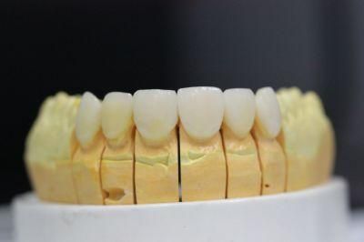 Porcelain Veneers/Dental Veneers From Midway Dental Lab