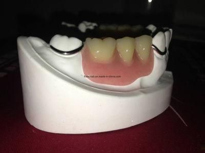 Removable Metal Framework Denture