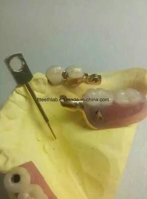Dental Material Lab Implant Dental Lab Custom Metal Cast Partials with Mk1 Attachment From China Dental Lab