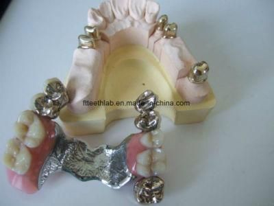 Dental Telescope Overdenture From China Dental Lab