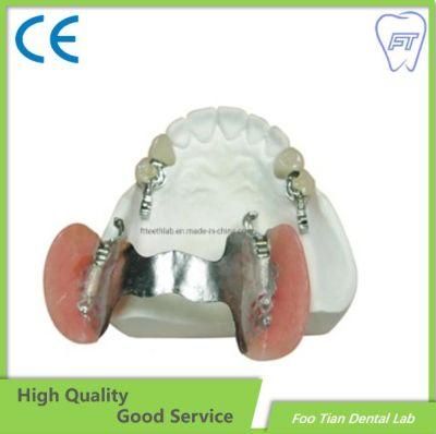 Dental Implant Removable Metal Denture Cast Partial Framework