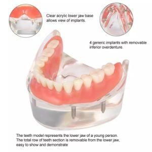 High Quality PVC Removable 32 Dental Hospital Standard Tooth Model