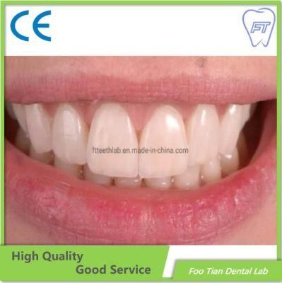 Veneer Orthodontics Treatment Custom Abutment on Selling