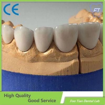 Dental Lab Emax Dental Inlays and Crowns with High Aesthetic Customized